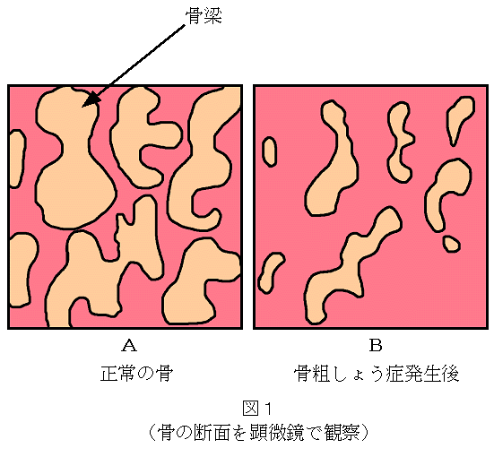 希少】我が国で20年以上前より使用されてきた人工関節手術の成績